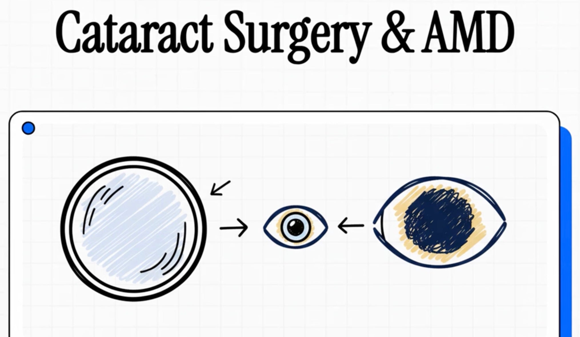 Cataract Surgery and Age-Related Macular Degeneration: A Comprehensive Review of Long-Term Outcomes, Pathophysiological Mechanisms, and Clinical Implications